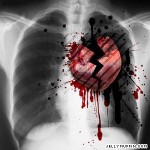 Το σύνδρομο της ραγισμένης καρδιάς μιμείται την καρδιακή προσβολή